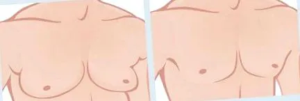 gynecomastia