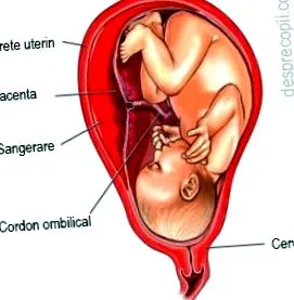 retroplacenta hematoma