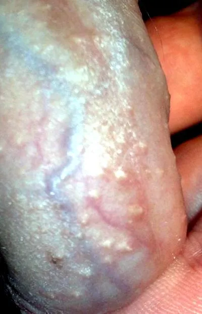 Urovaxon prosztata