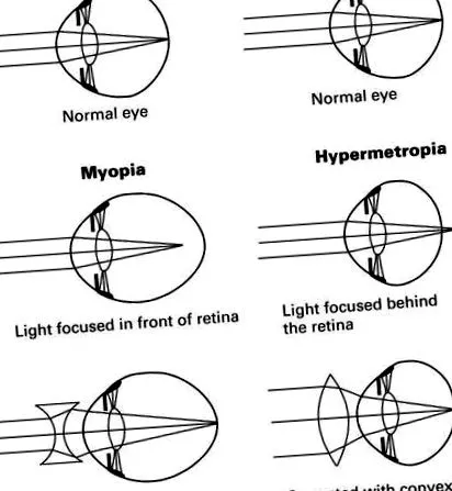 hyperopia