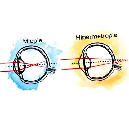 hyperopia
