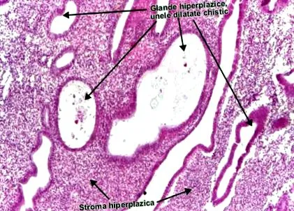 endometrium hiperplázia