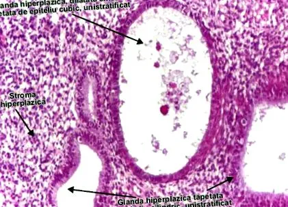 Egyszerű endometrium hiperplázia