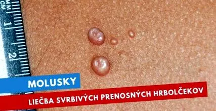 nitrikum vírus
