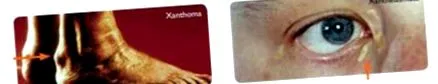 hypercholesterolémia