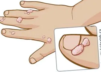 papilloma papilloma