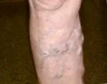 венозна