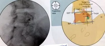 epidurális térbe
