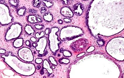 papilloma intraductalis