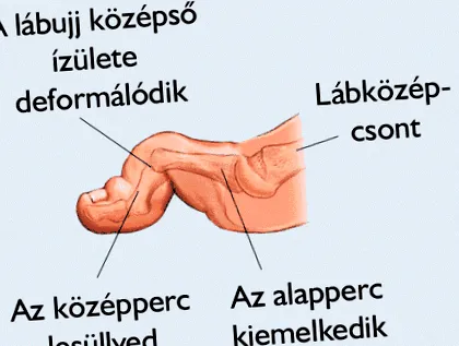 lombare sindroame