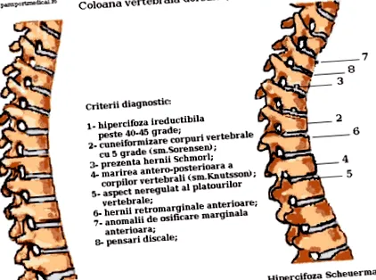 hyperkyphosis