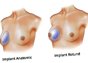 szilikon implantátummal