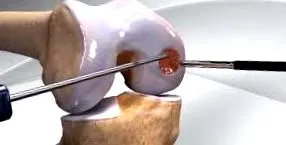 ízületi folyadék