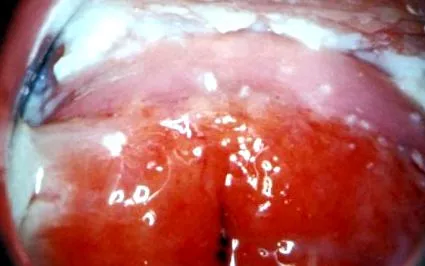 candidiasis