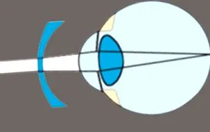myopia