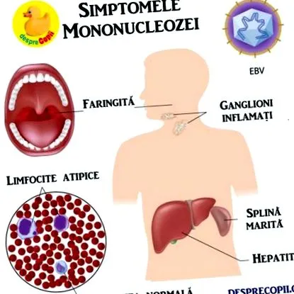 mononukleóza