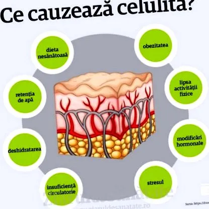 cellulit