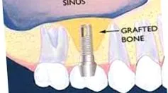 maxilláris sinus