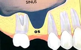 maxilláris sinus