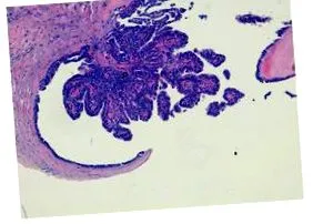 papilloma
