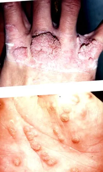 humán papilloma