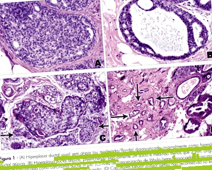 papilloma