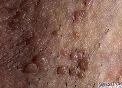 papilloma