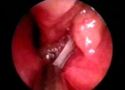 papilloma