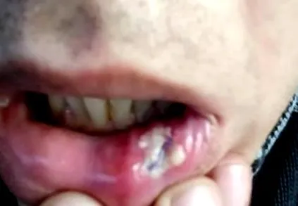 papilloma