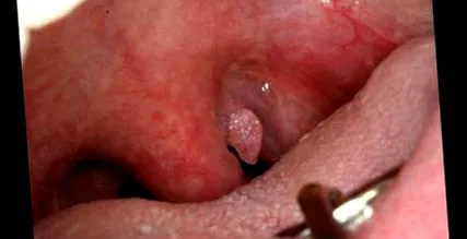 papilloma