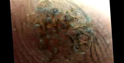 papilloma
