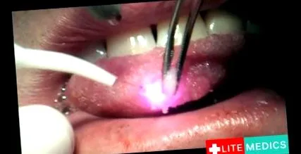 papilloma