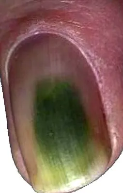 elszíneződés