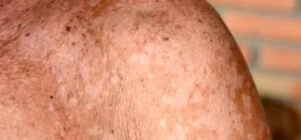 pityriasis