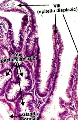 polip pediculate