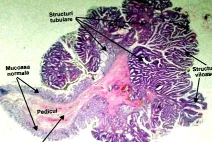 adenomatózus tubulo-villous polip