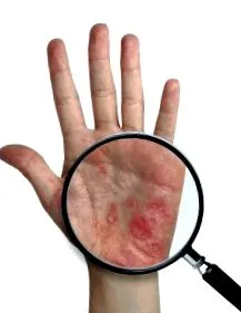 psoriasis