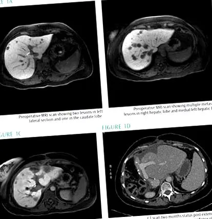 Enterobiosis Diéta
