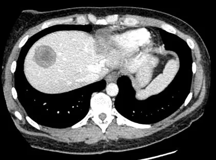 Oxyurosis Enterobiosis