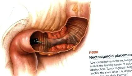 stent