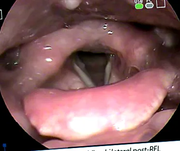 reflux betegség