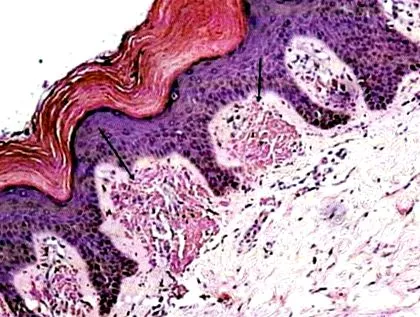 papillomatosis papillomatosis hyperkeratosis