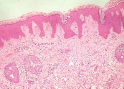 hyperkeratosis hyperkeratosis