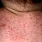 eruptív eruptív