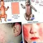eruptív roseola
