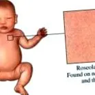 roseola roseola