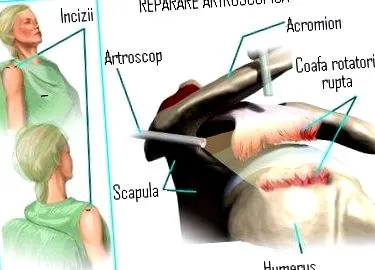 vállízület osteoarthritisének vállízület osteoarthritisének