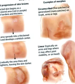 sclerodermia