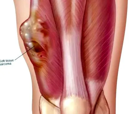 Arthritis Arthritis Arthritis lábszarkóma