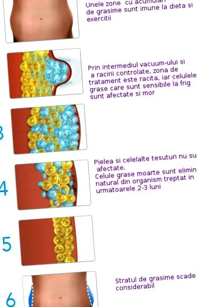 criolipolisa